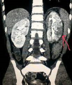 KIDNEY-ABSCESS