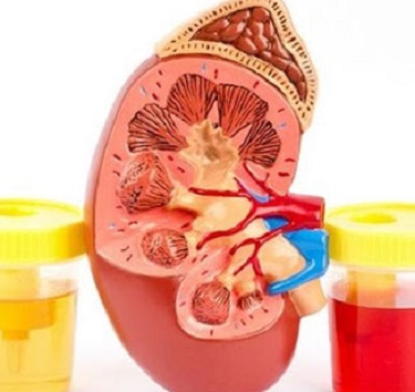 Hematuria